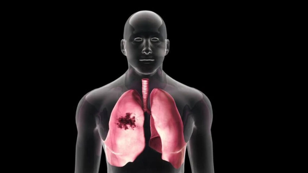 Lungenembolie wie schnell stirbt man