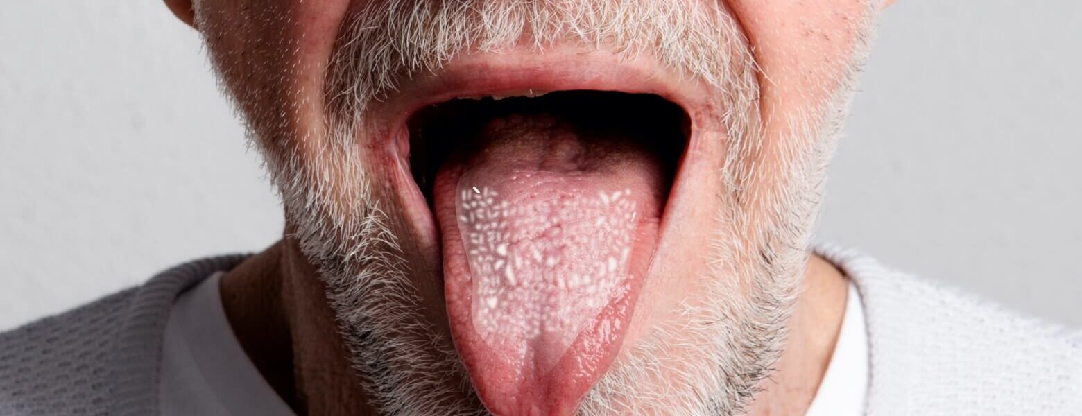 Symptome wenn Candida abstirbt