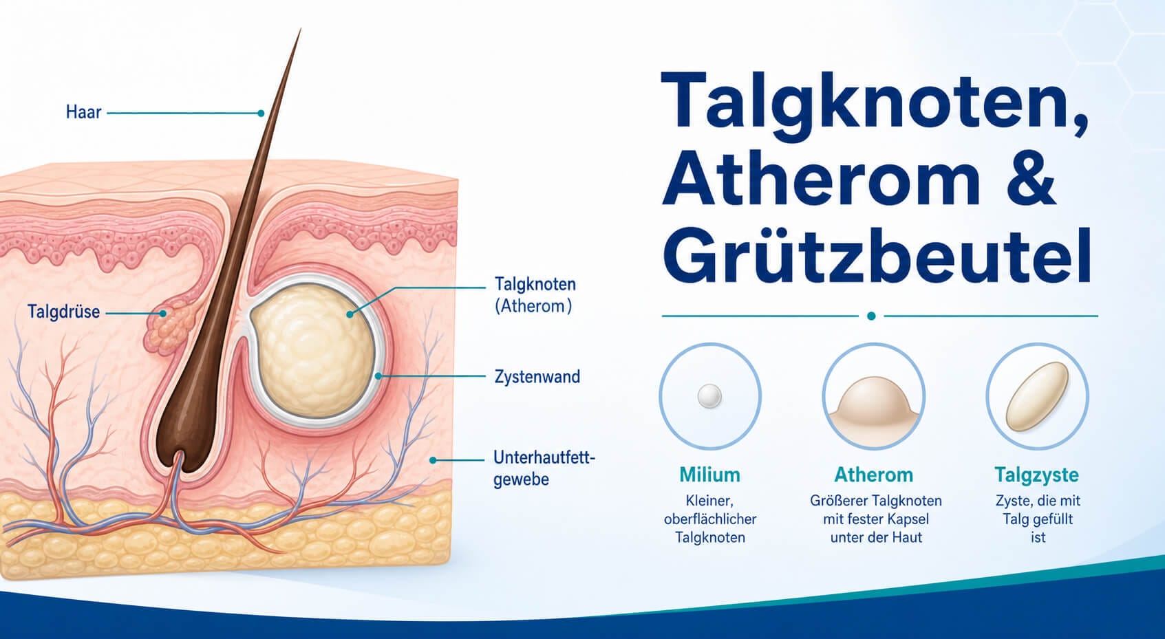 atherom entfernen · talgzyste · grützbeutel · talgknoten schamlippe · verstopfte talgdrüse · atherom entzündet · atherom behandlung ohne operation